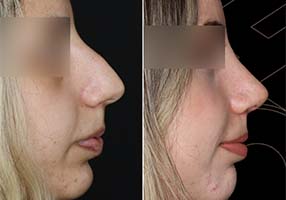 Rhinoplasty